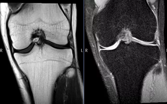 Knee MRI scan