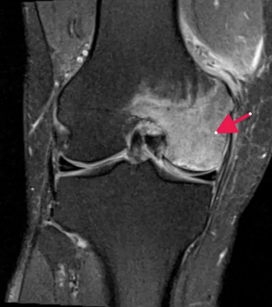 Avascular necrosis of the knee